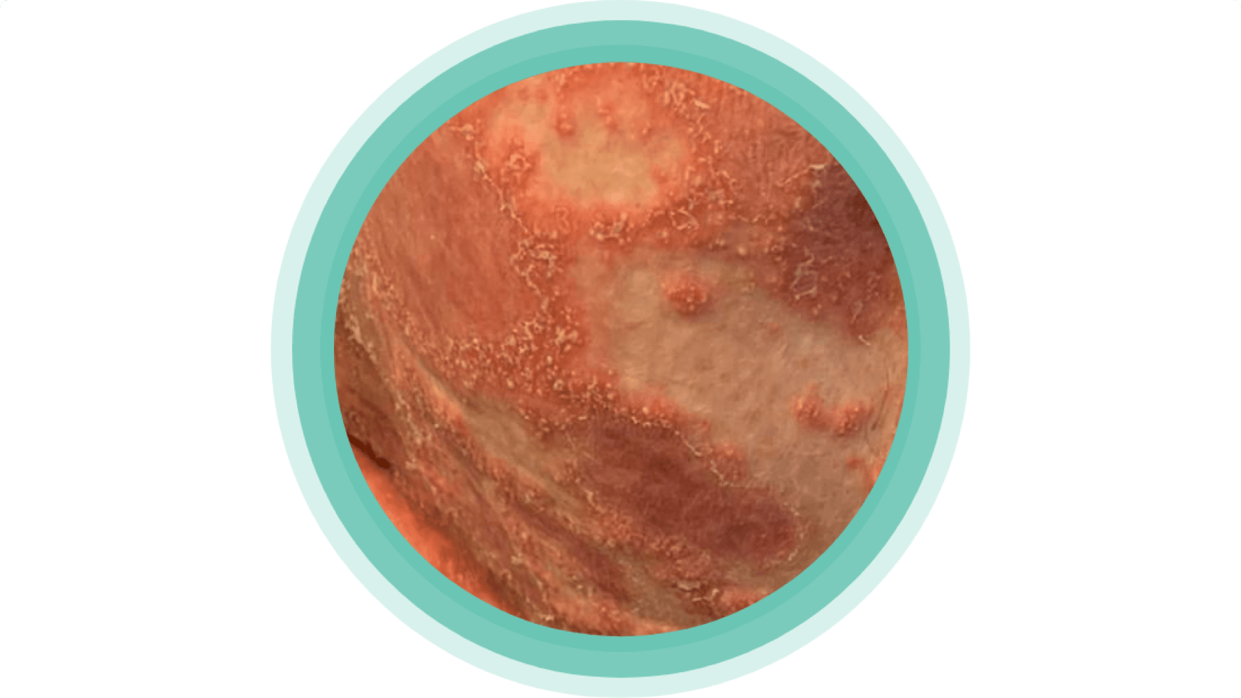 popáleniny, spouštěče, rozšířené pustuly, zvládání onemocnění GPP, Act4GPP